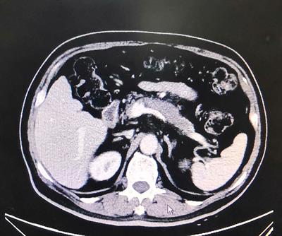 A Diabetic Patient Complicated With Pancreatic Cancer After Using Liraglutide: A Case Report